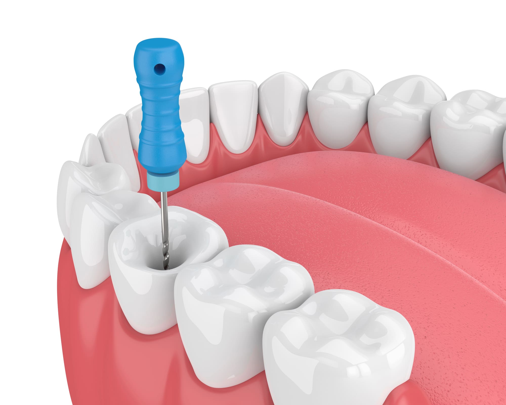 Signs of Infection After Wisdom Teeth Removal Symptoms to Watch For and When to See a Dentist