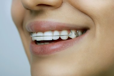Orthodontic Retainers 101: Types, Benefits & How to Care for Yours