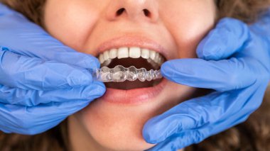 The Best Retainers for Teeth Shifting: What to Know Before You Buy