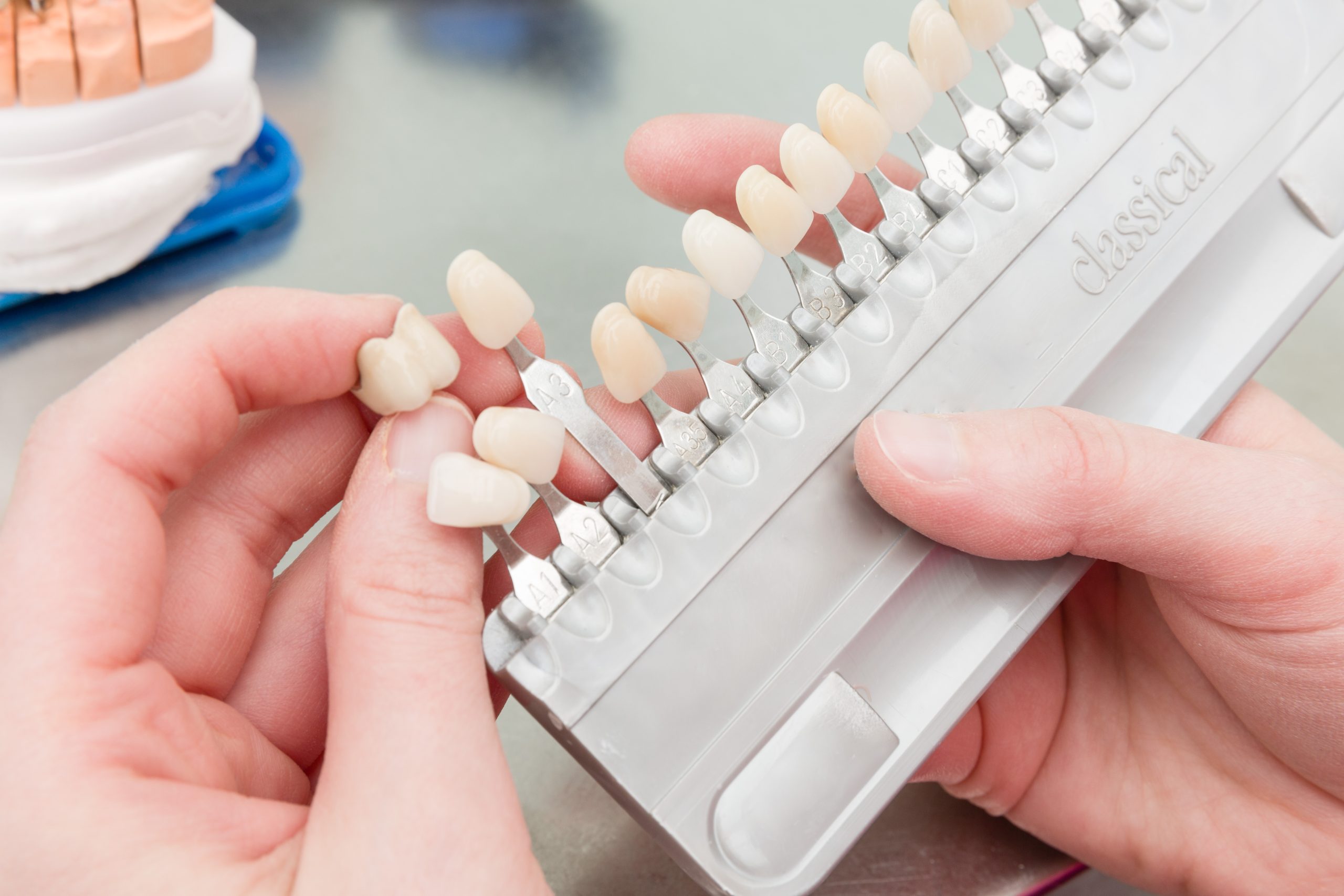 Dental Veneer Cost Breakdown: What Influences the Price?
