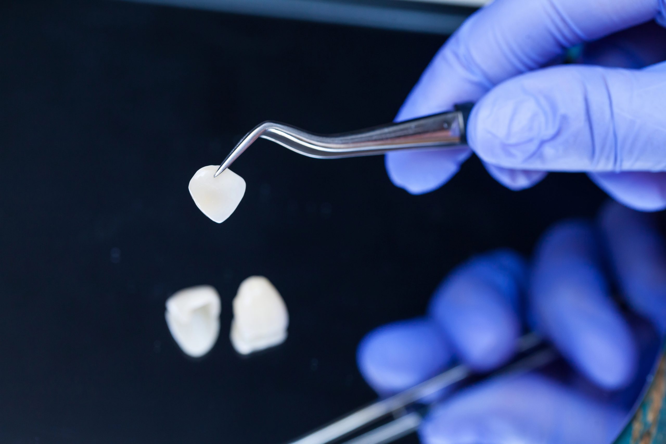 Dental Veneer vs Crown Differences: Which Option Is Right for You?