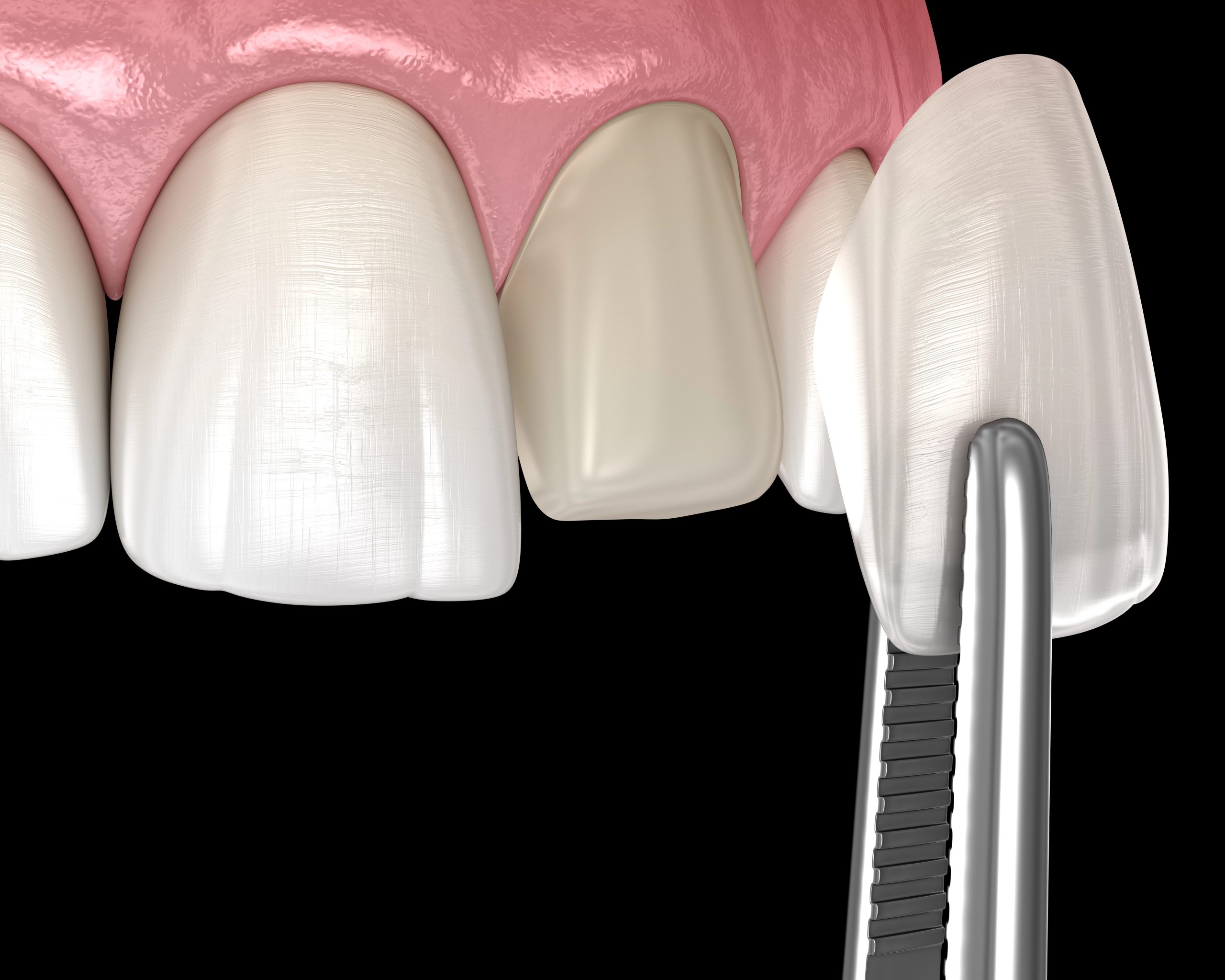 Dental Veneer Before and After Results: Real Transformations Explained