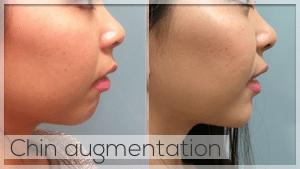Chin Filler Treatment Facelove Melbourne