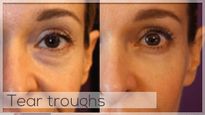 Tear trough treatment Facelove Melbourne