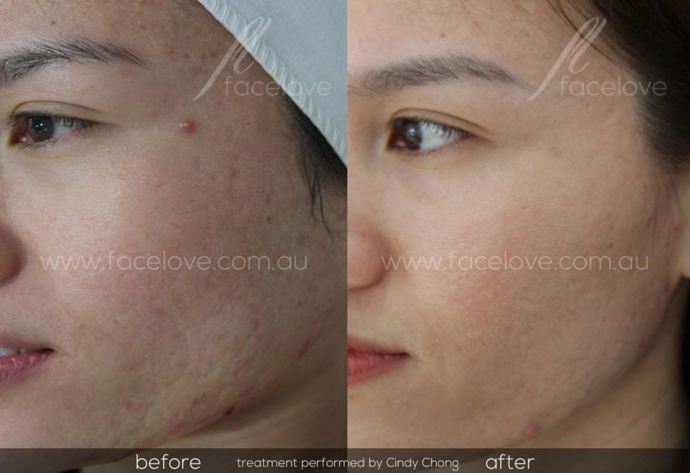 How to get rid of acne scars with Dermapen How to get rid of acne scars with Dermapen