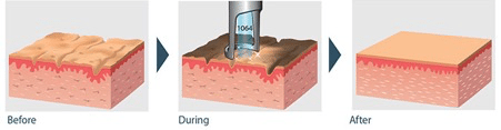 Carbon Laser Peel Explained