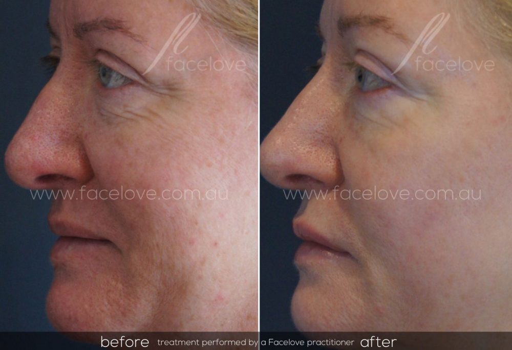 Dermapen Skin Needling treatment Before and After at Facelove