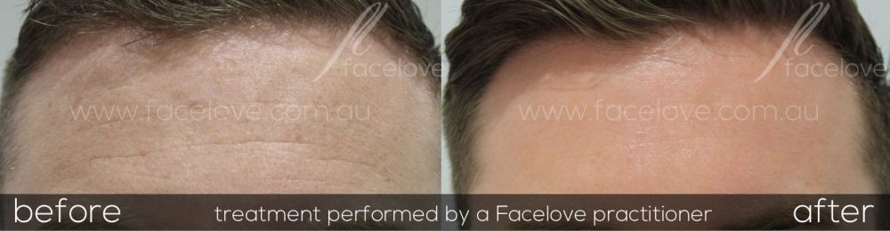 Male CO2 laser treatment Before and after at Facelove