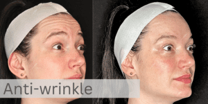 Anti-wrinkle Injections Facelove Melbourne