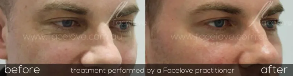 Male-CO2-laser-treatment-45-Before-and-after-at-Facelove-1080x281 Before and after COâ‚‚ laser resurfacing treatment