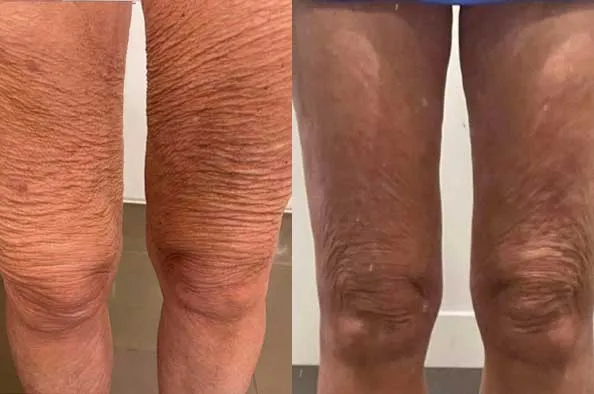 Doorbreek de mythes: Echte feiten in deze Liquid Collagen Review 23 vloeibare collageen benen