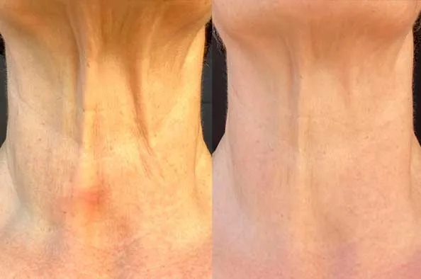 Doorbreek de mythes: Echte feiten in deze Liquid Collagen Review 26 vloeibaar collageen nek