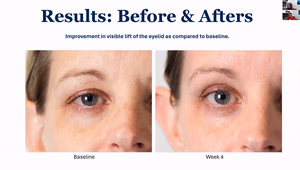 Antes Depois Resultados Truescience Activated Skin Care Collection | Nutrigenomics Store 4 Antes e depois de mostrar a elevação dos olhos e a redução das bolsas