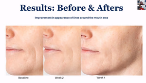 Antes Depois Resultados Truescience Activated Skin Care Collection | Nutrigenomics Store 5 Antes e depois da redução das rídulas à volta da boca