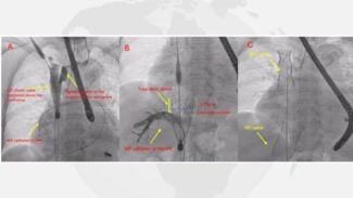 imaging of tricvalve¨ implantation