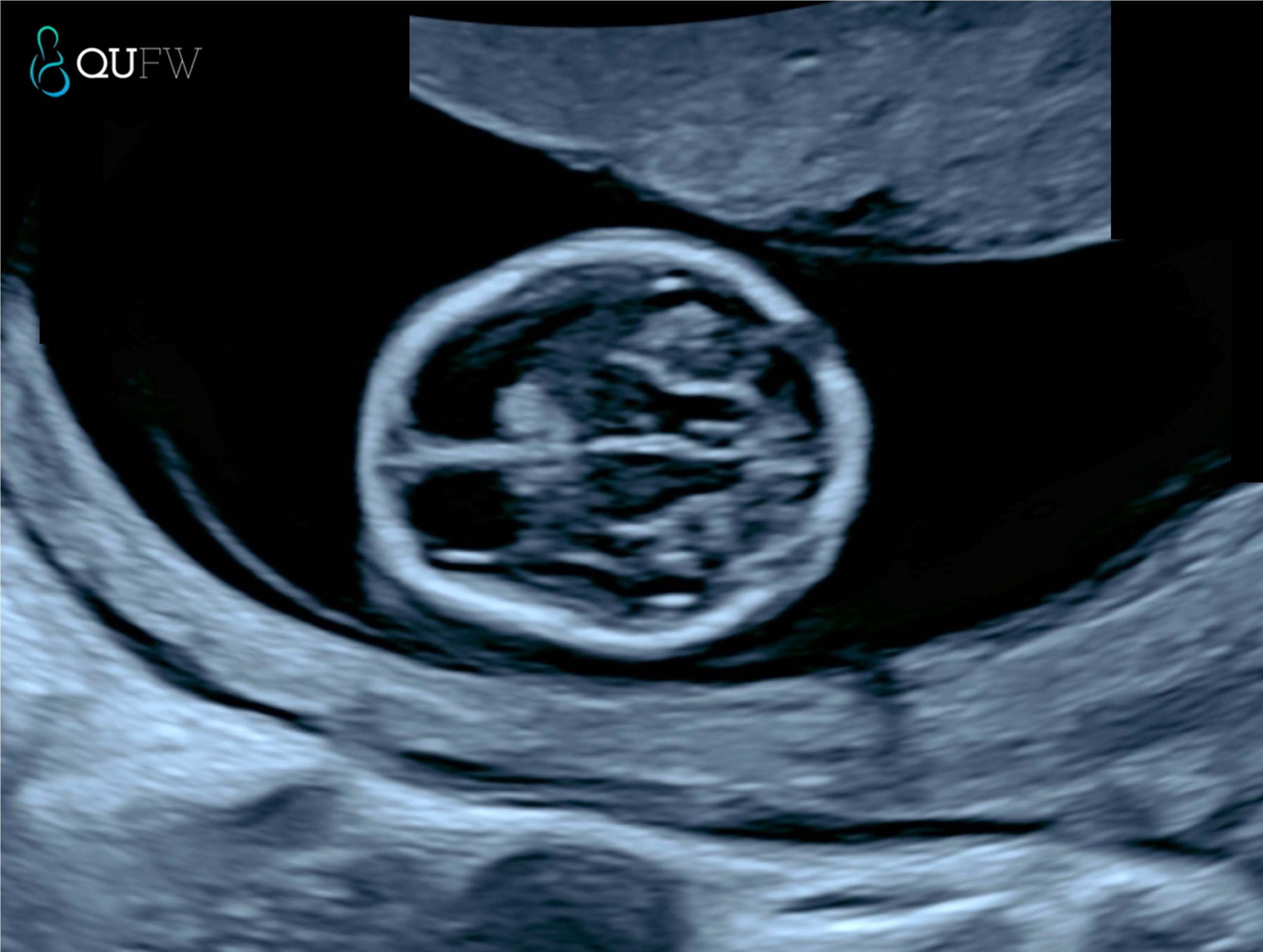 Early structural assessment of the fetal brain