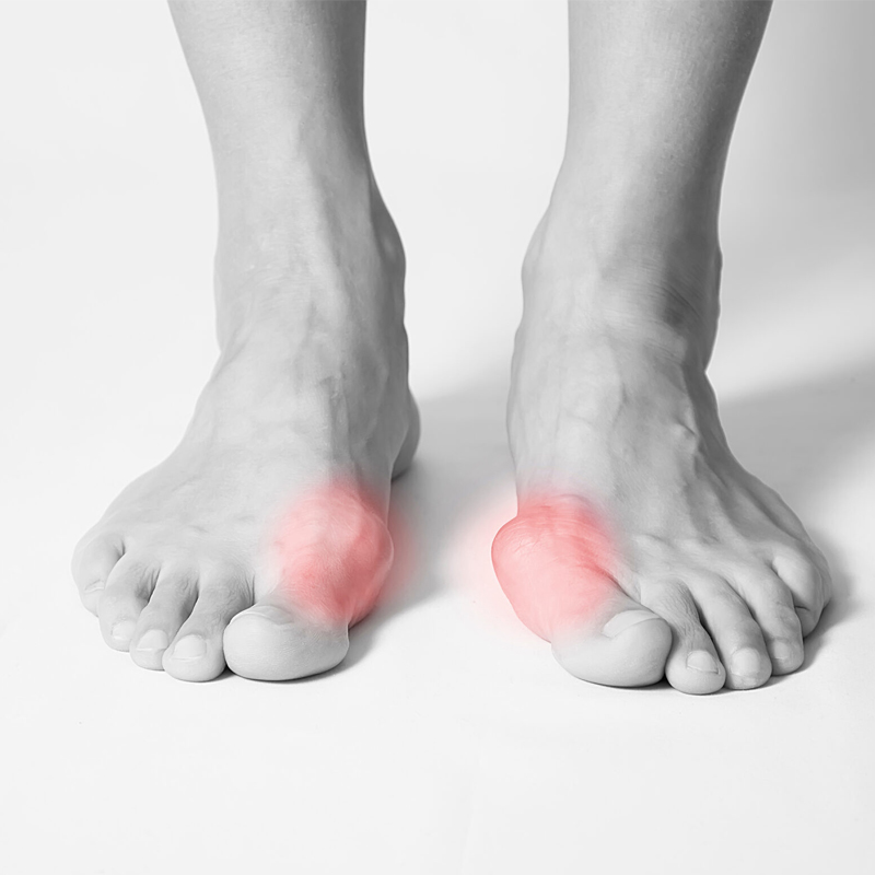 Bunios-Art-of-foot-Ankle
