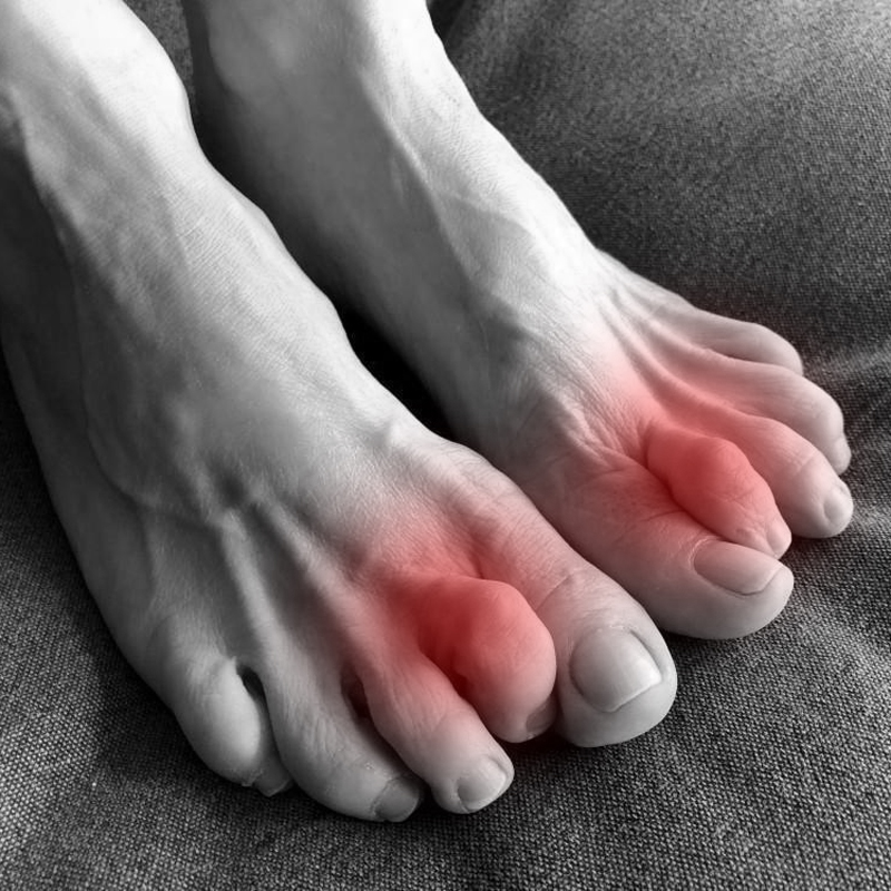 Hammertoes-Art-Of-Foot-Ankle