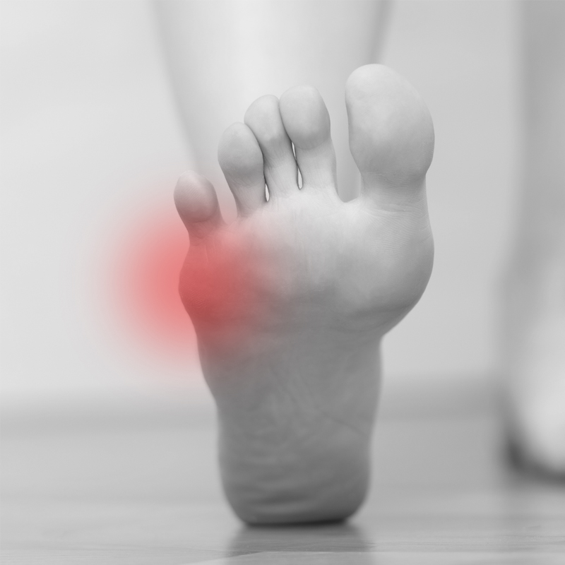 Tailor-Bunions-Art-Of-Foot-Ankle