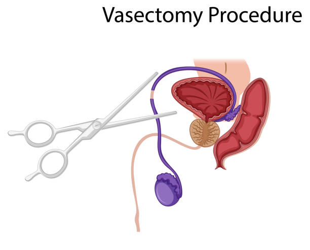 Atenciรณn y microcirugรญa para vasectomรญa reversible en Mรฉxico 2 Vasectomรญa reversible