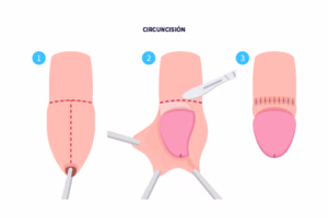 ¿Por qué se recomienda la circuncisión en casos de fimosis? 1 circuncisión en Tijuana