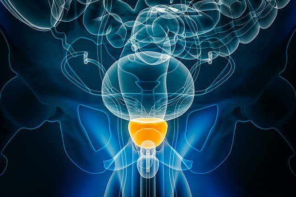¿Qué opciones existen para tratar el cáncer de próstata sin cirugía? 1 tratamiento para el cáncer de próstata en Tijuana