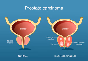 ¿Qué opciones existen para tratar el cáncer de próstata sin cirugía? 2 tratamiento para el cáncer de próstata en Tijuana
