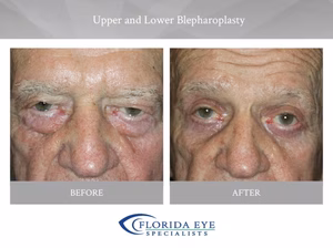 Upper and Lower Blepharoplasty