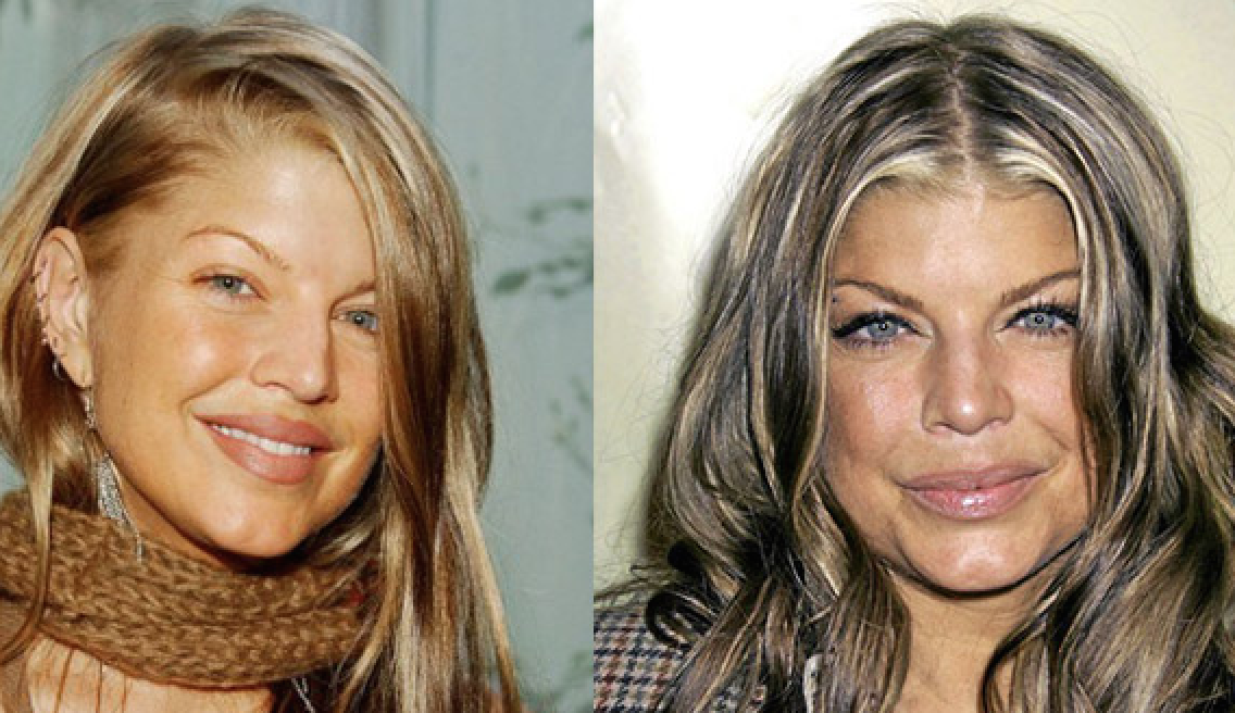 fergie http-::welikeit.fr:76758:top-20-des-stars-avant-et-apres-la-chirurgie-esthetique