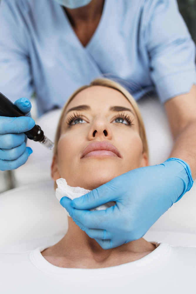 microneedling