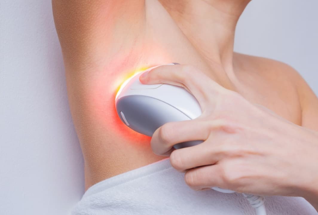L’option lumière pulsée pour une épilation semi définitive