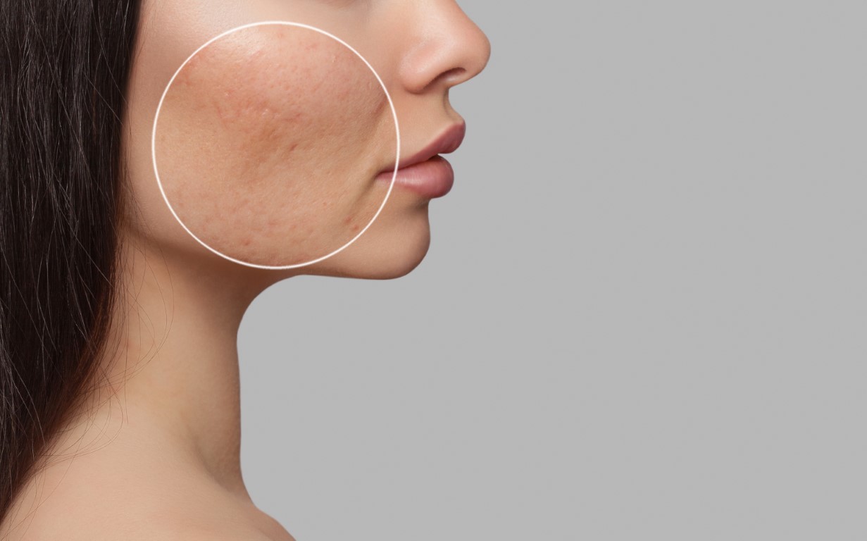 hyperpigmentation