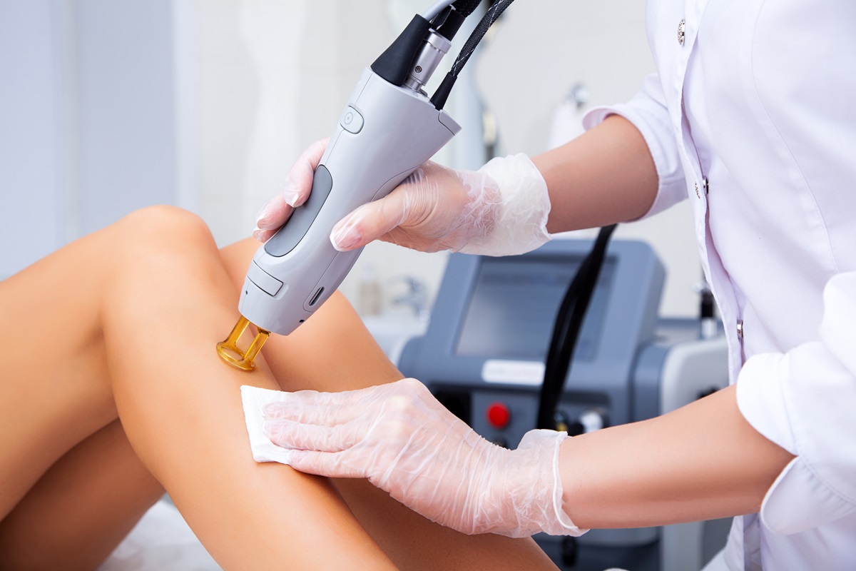 Quels sont les avantages de l'épilation laser