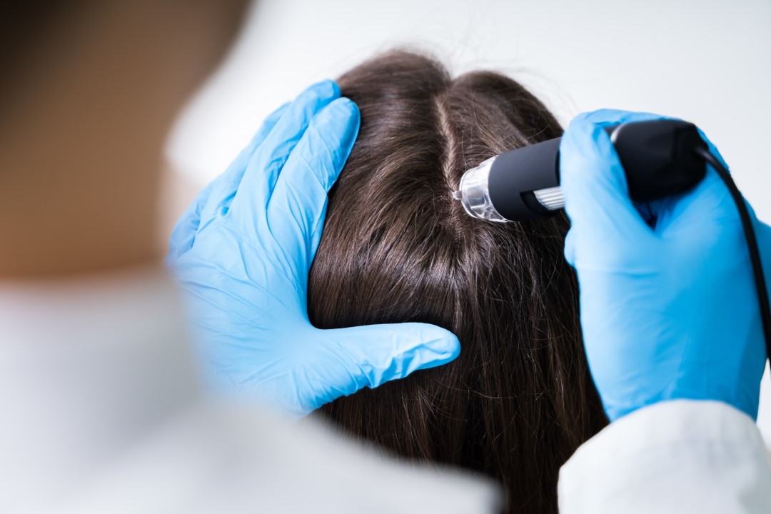 laser alopécie cheveux