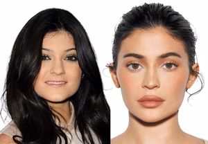 Kilie Jenner chirurgie esthétique avant apres