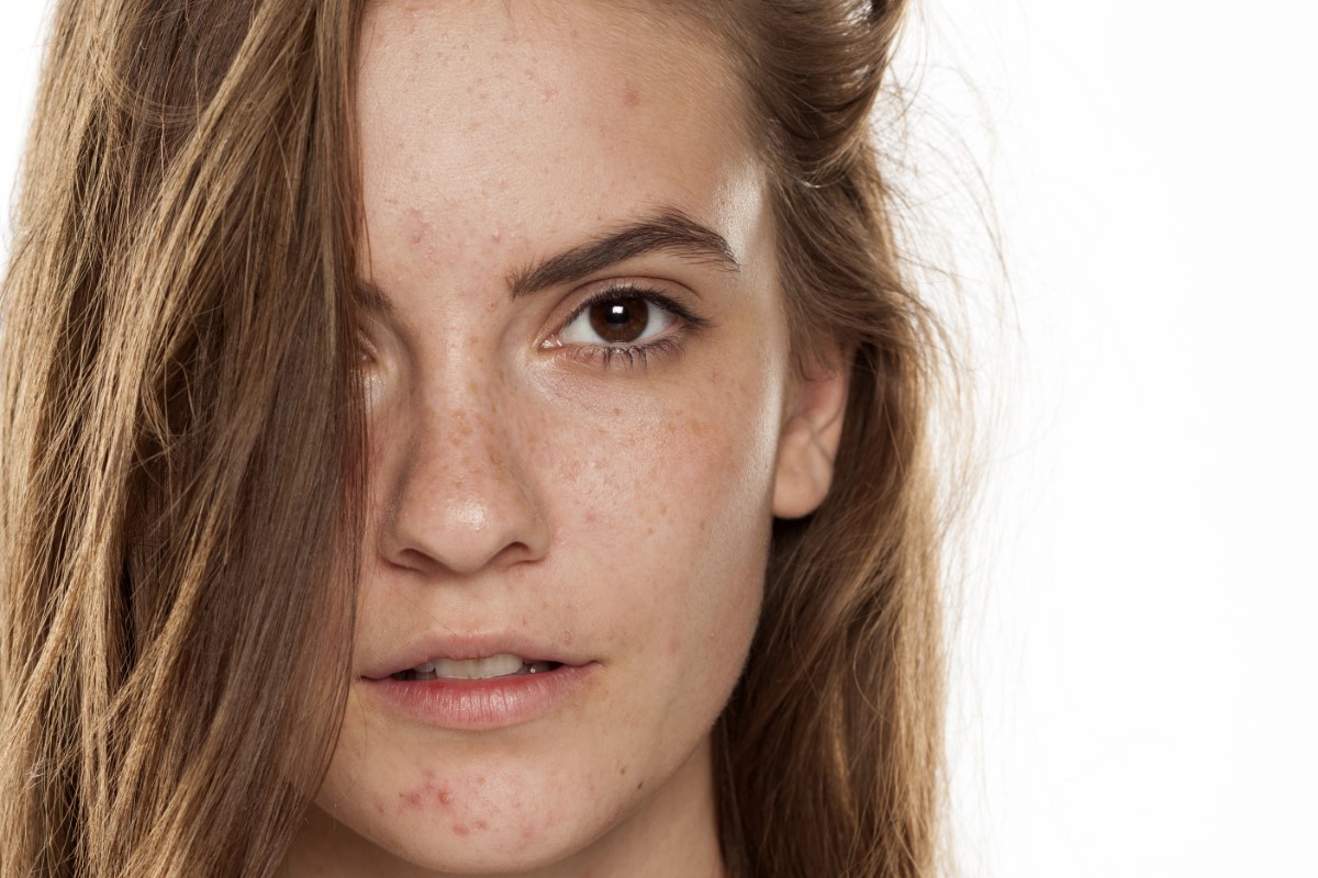 melasma causes solutions (3)
