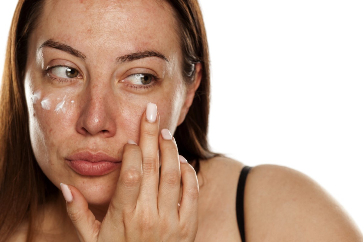 melasma causes solutions (3)
