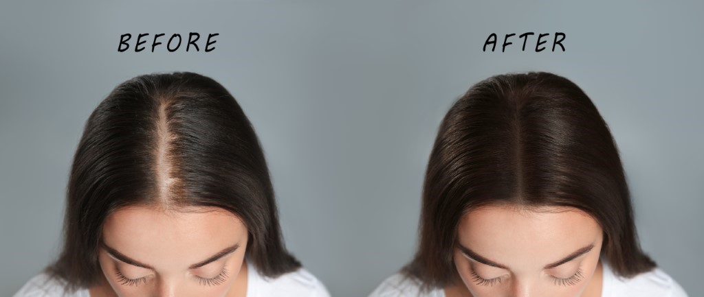 traitement anti chute cheveux femme