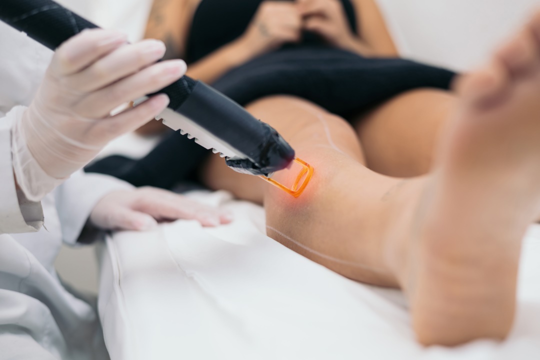 épilation laser jambe