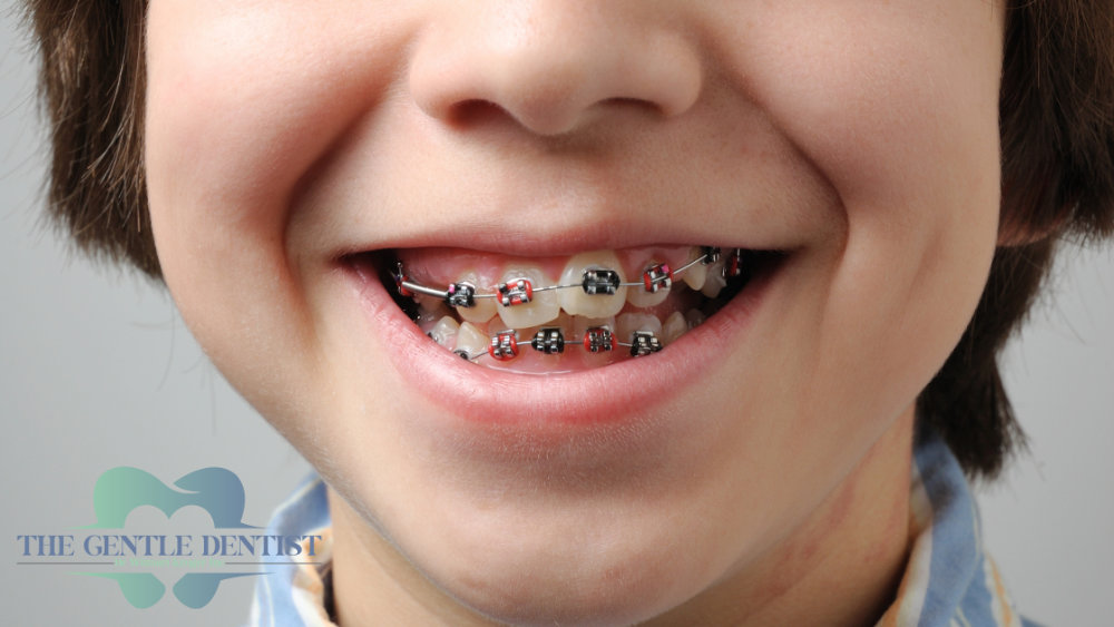 Interceptive Orthodontics Featured Child with braces showcasing the power of interceptive orthodontics.