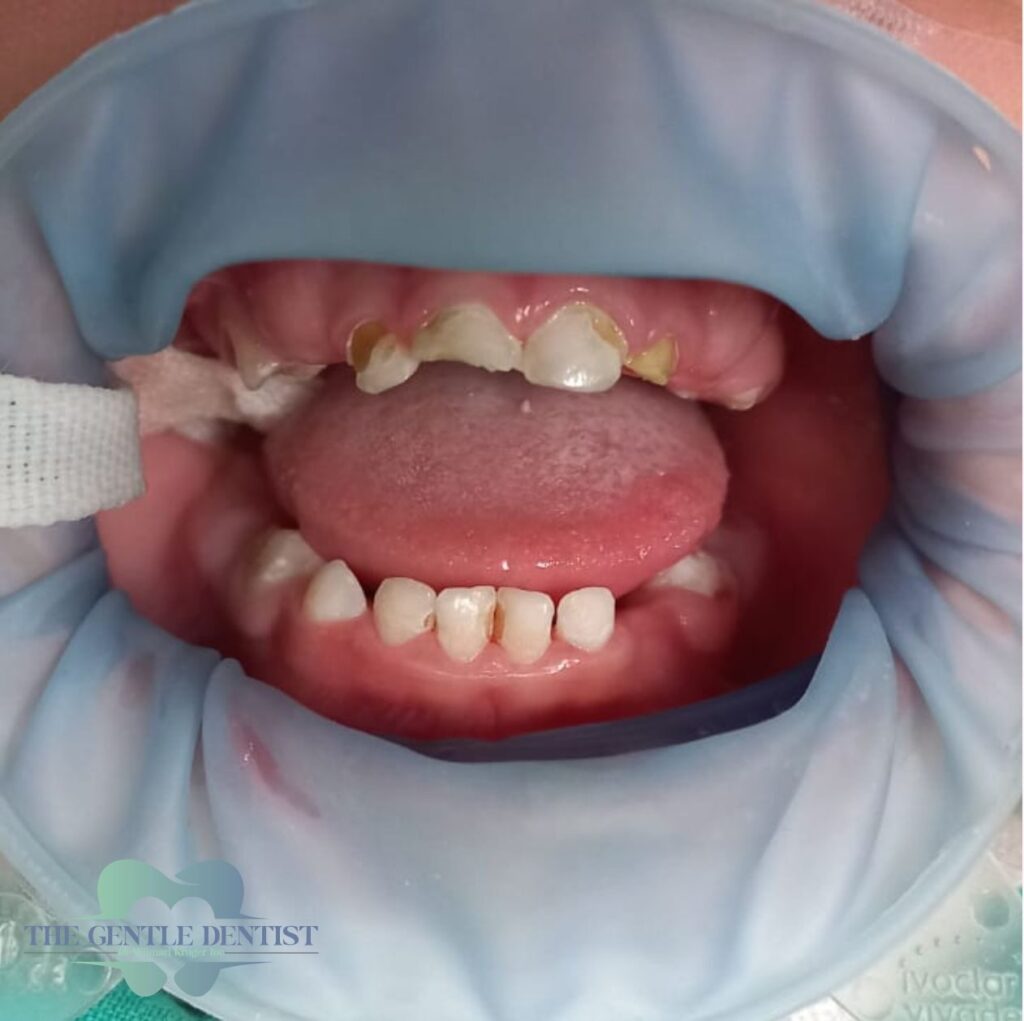 Baby Bottles Can Harm Your Child’s Teeth: Spot It Early and Save Their Smile 3 Advanced case of bottle mouth syndrome in a young child.