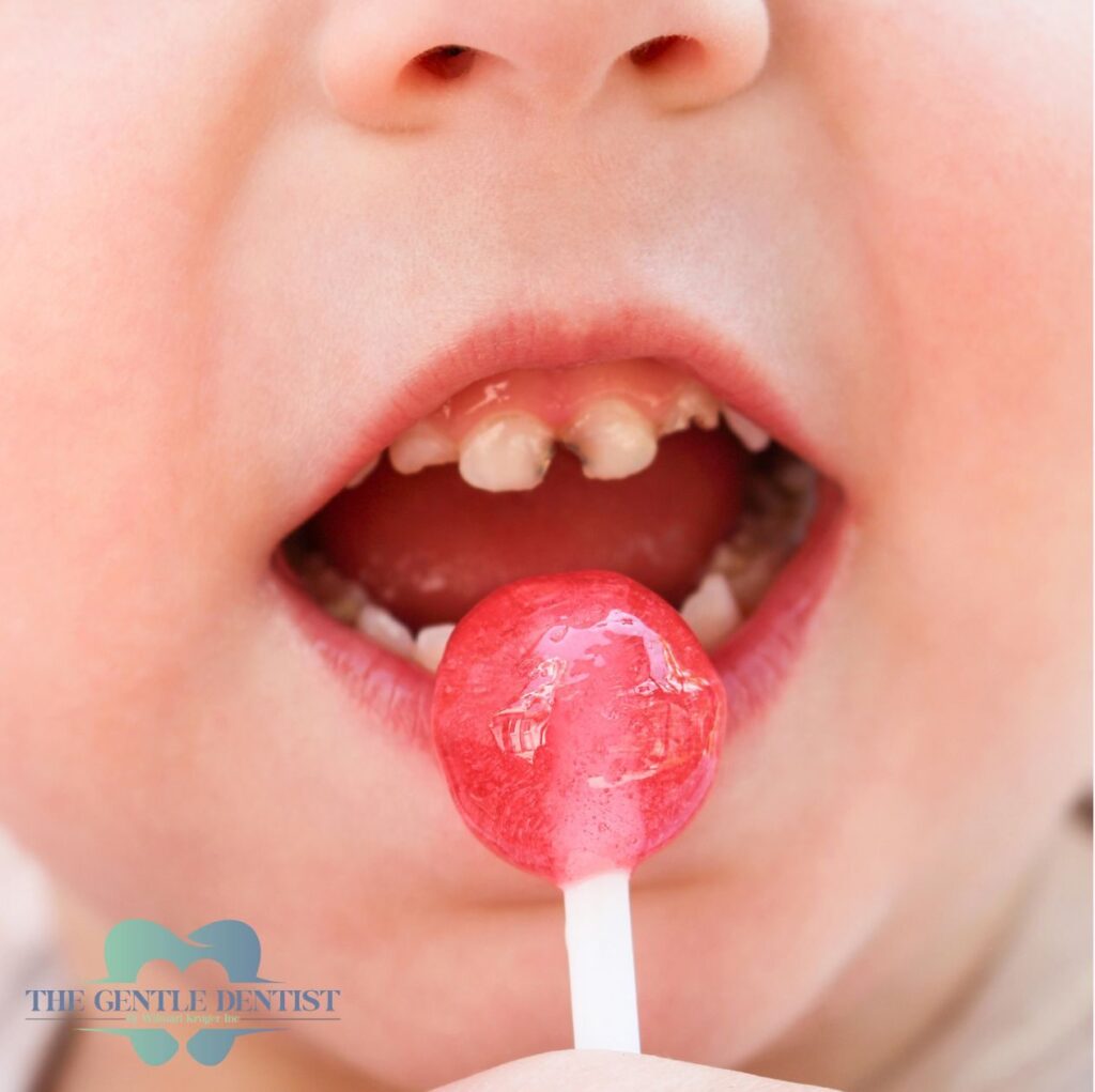 Baby Bottles Can Harm Your Child’s Teeth: Spot It Early and Save Their Smile 2 Child with visible tooth decay eating a lollipop, highlighting sugar’s role in early childhood cavities and enamel damage.