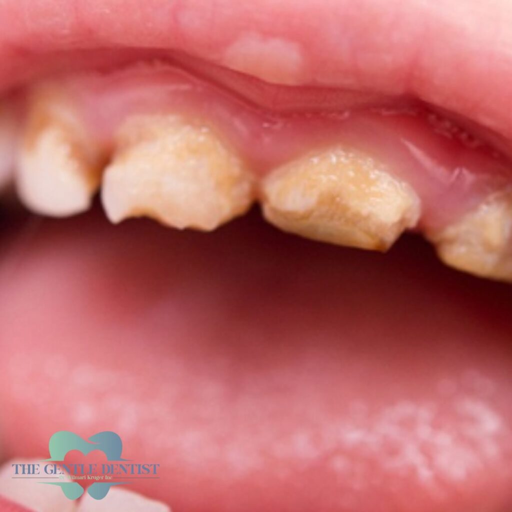 Baby Bottles Can Harm Your Child’s Teeth: Spot It Early and Save Their Smile 1 Close-up of severe tooth decay in a child, showing enamel erosion caused by bottle mouth syndrome.