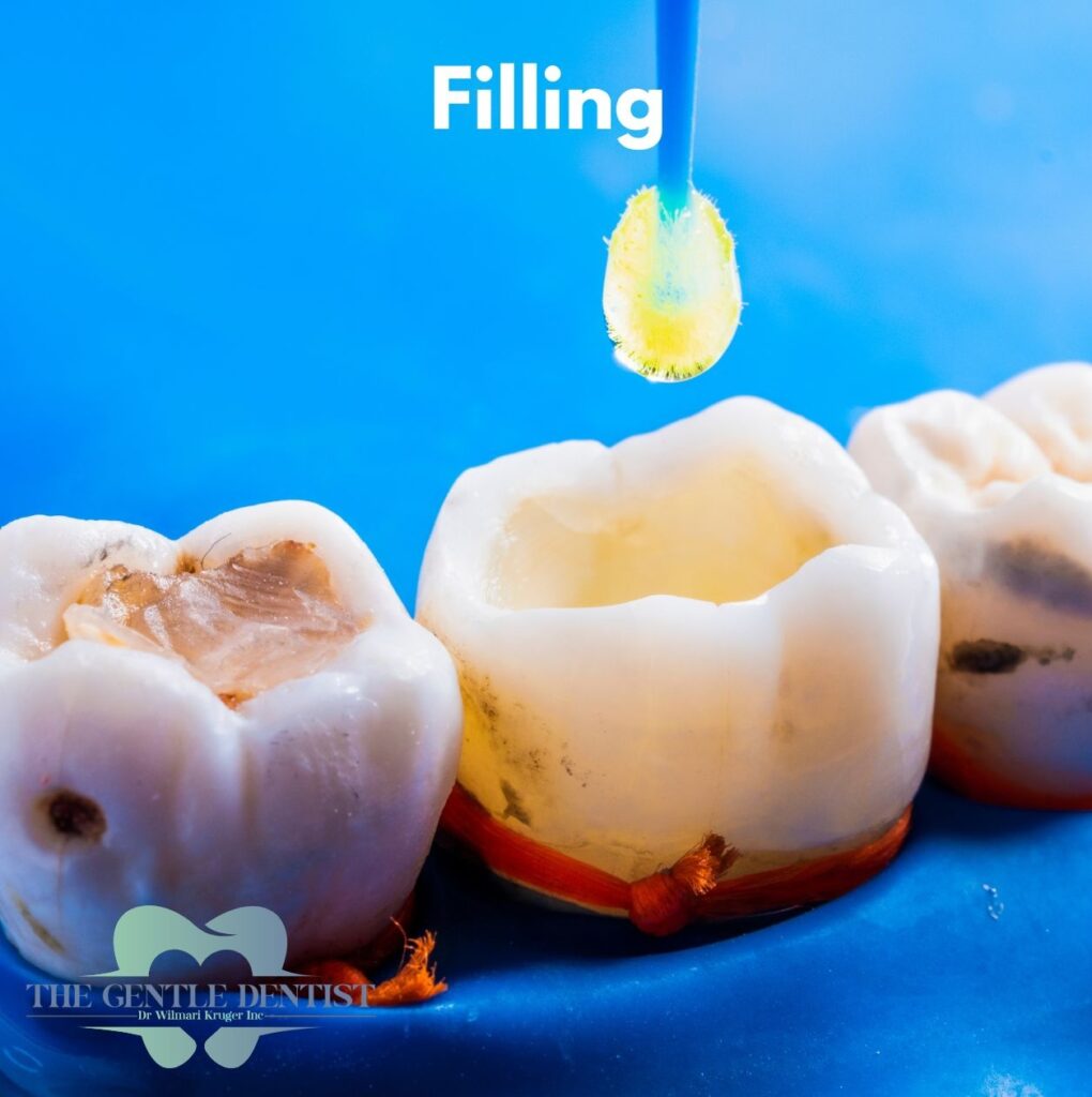Filling or Crown: How Dentists Decide (and What It Means for You) 2 Composite filling procedure in progress at The Gentle Dentist, Centurion. Bonding agent on prepared molar.