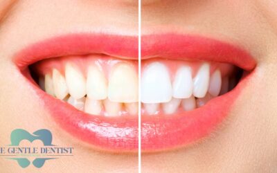 BLOG 6 Is Professional Teeth Whitening Safe? Why It Won’t Damage Your Teeth