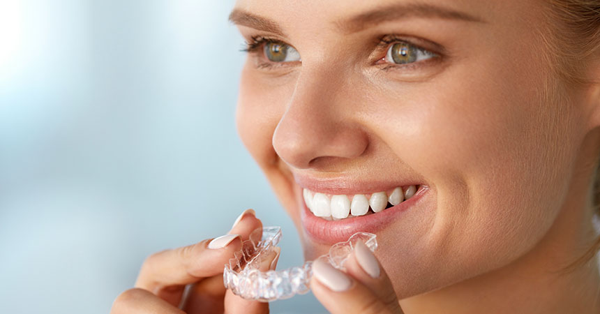 clear-aligners