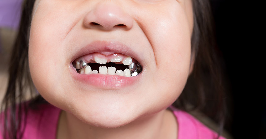 paediatric-endodontics