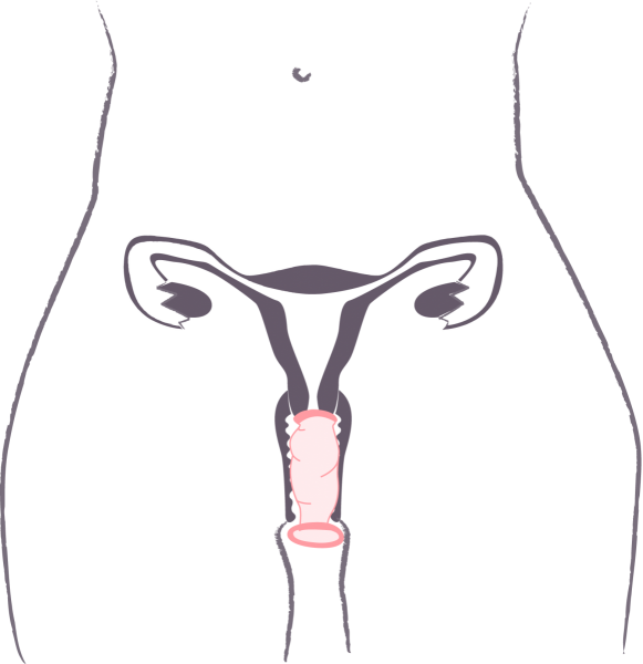 préservatif féminin