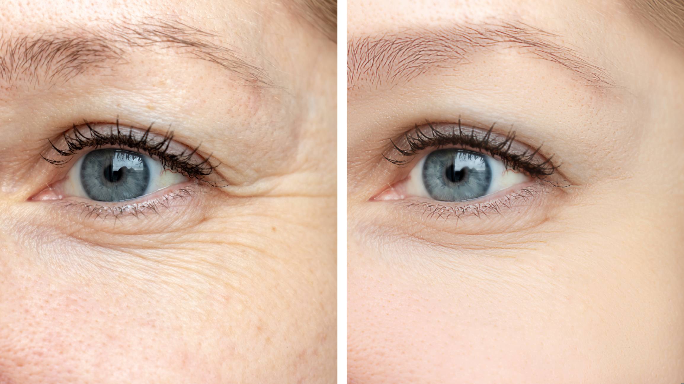 l-injection-de-botox-est-elle-sans-risques